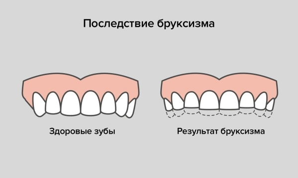 Что такое бруксизм и почему его нельзя игнорировать?