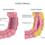 Диарея, боли в животе и другие симптомы болезни Крона