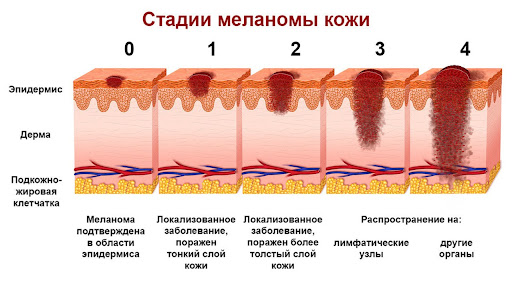 5 признаков меланомы: зачем зимой проверять родинки