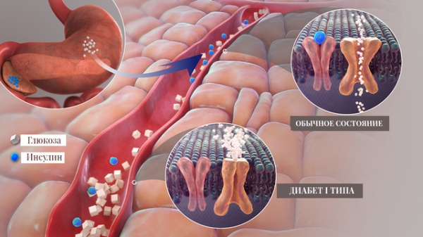 Диабет 1 типа: не смертельно, хотя и не лечится